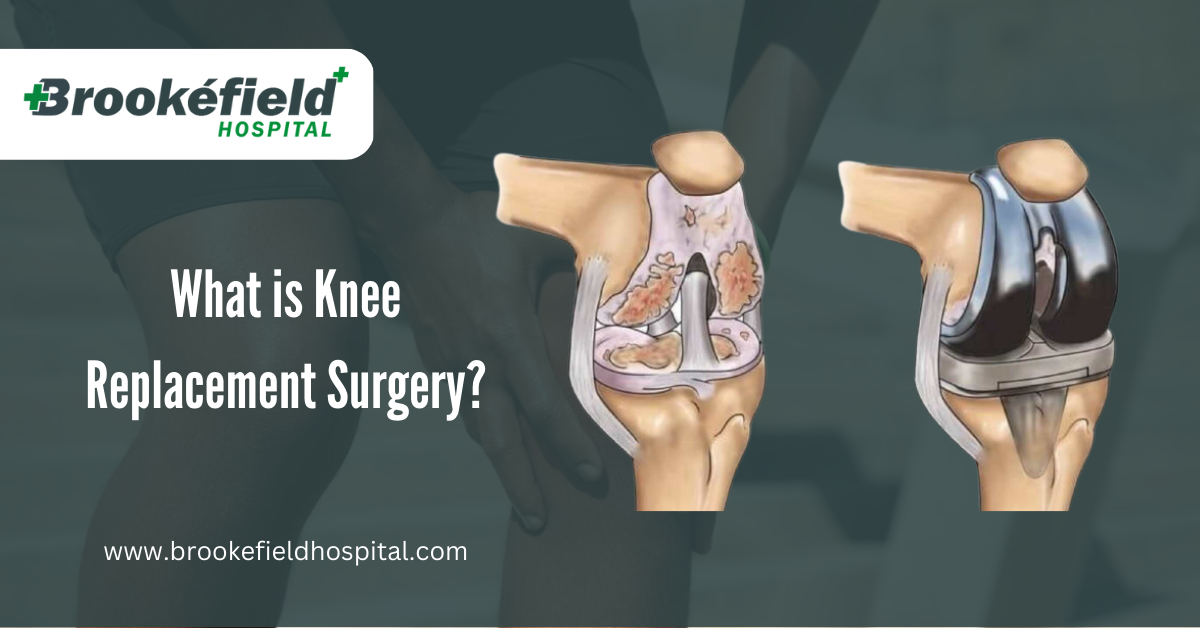 Knee Replacement Surgery